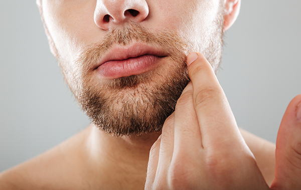 Trasplante de barba